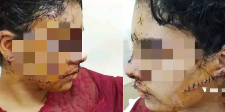 اعتداء وحشي على سيدة في تازة: طليقها يشوّه وجهها بعد زواج قسري وعنف مستمر